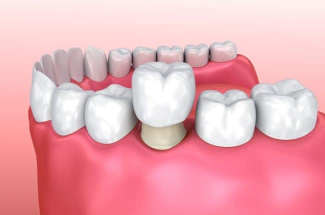 ¿Qué es una corona dental?