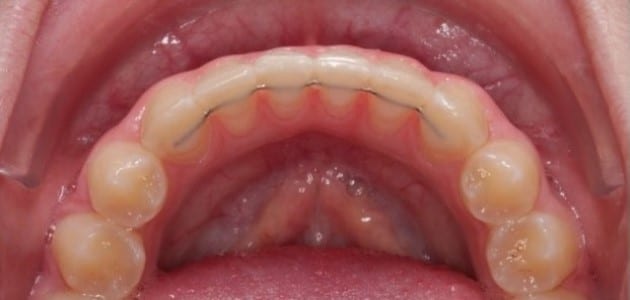 Tipos de retenedores dentales