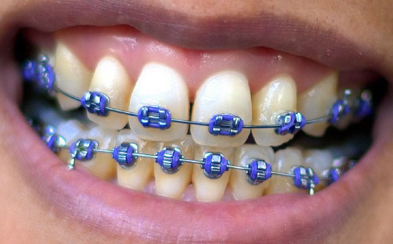 Brackets en clinica dental en pinto