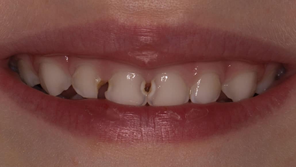 caries de biberón clinica dental pinto