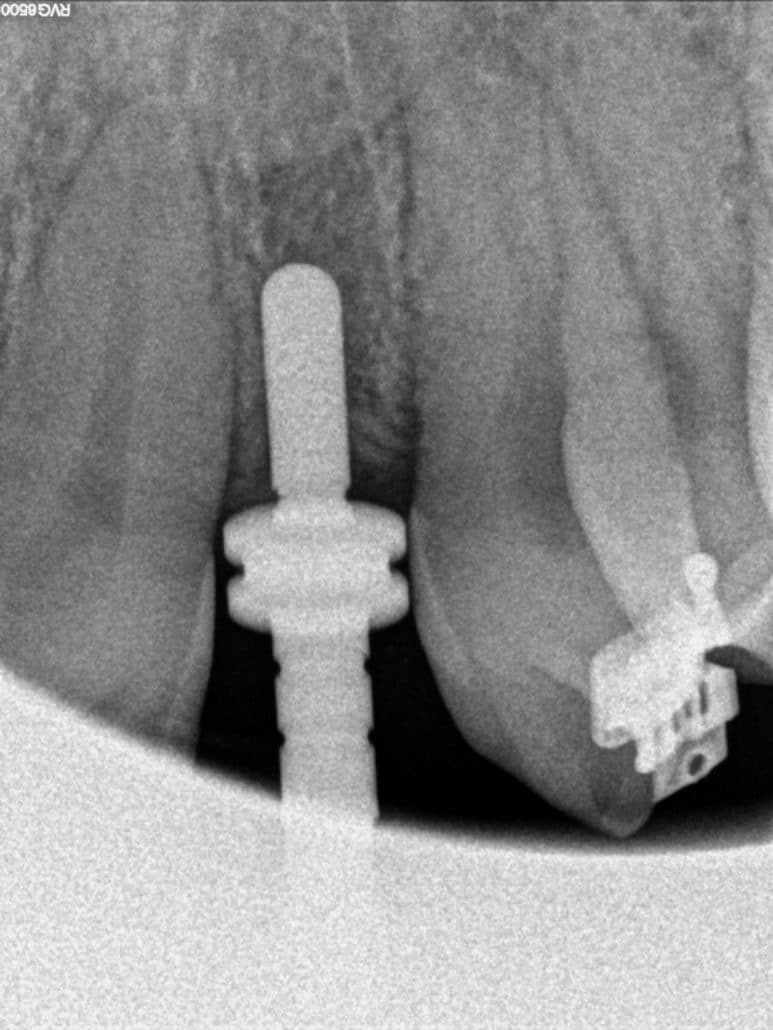 Colocación del implante Clínica Dental en Pinto Dres. de Benito