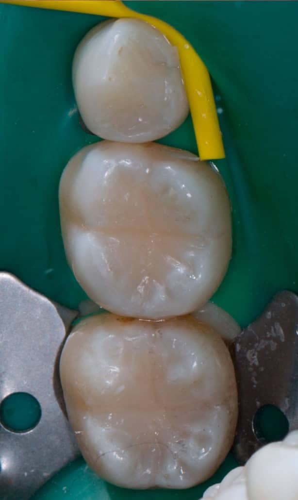 Después del empaste estético Clínica Dental en Pinto Dres. de Benito