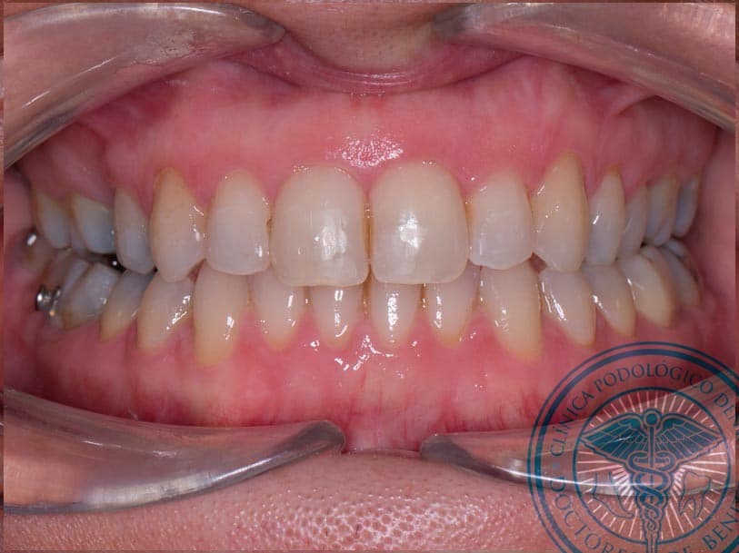 despues ortodoncia invisible invisalign pinto