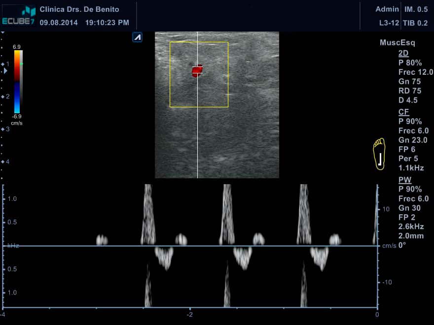 Ecógrafo alpinion ecografia doppler clinica podologica Pinto