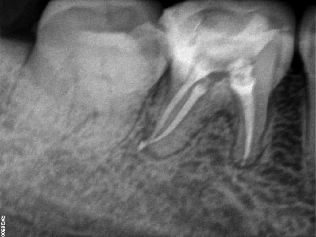 Endodoncia clinica dental en pinto