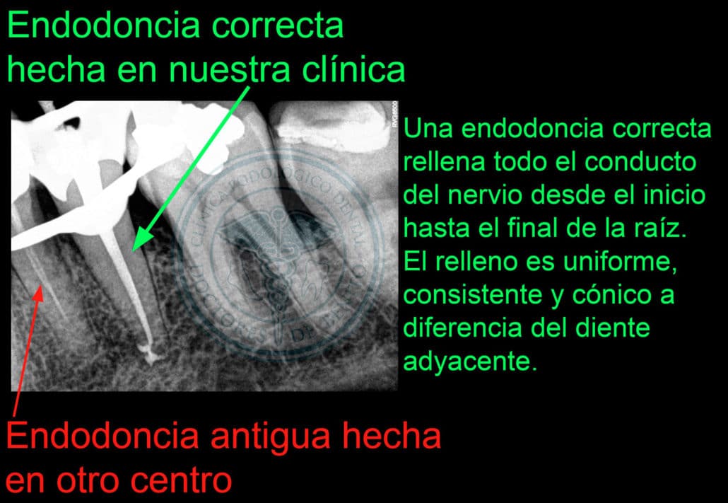 endodoncia clinica dental pinto