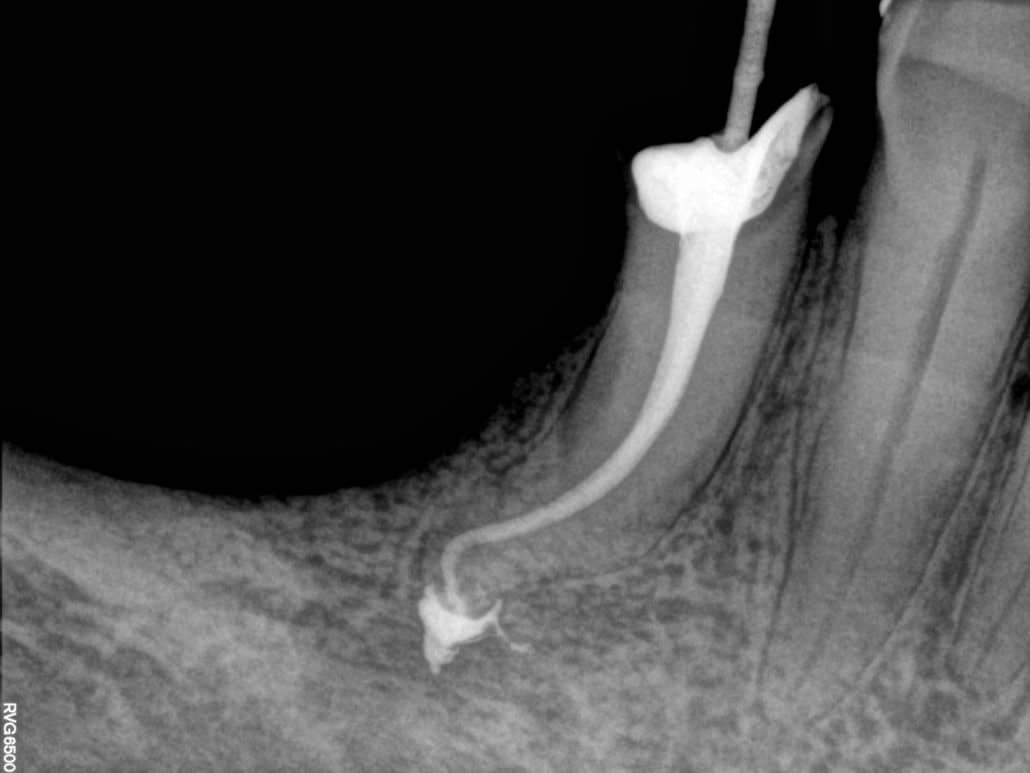 Endodoncia clinica dental en pinto