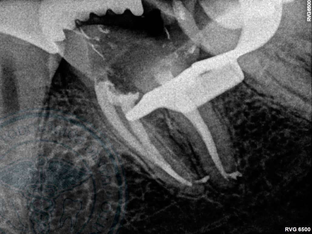 Endodoncia terminada clinica dental en pinto