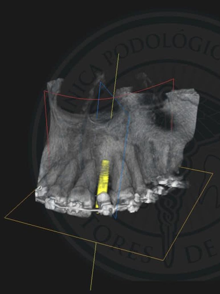 Escáner 3d implante 22 Clínica Dental en Pinto Dres. de Benito