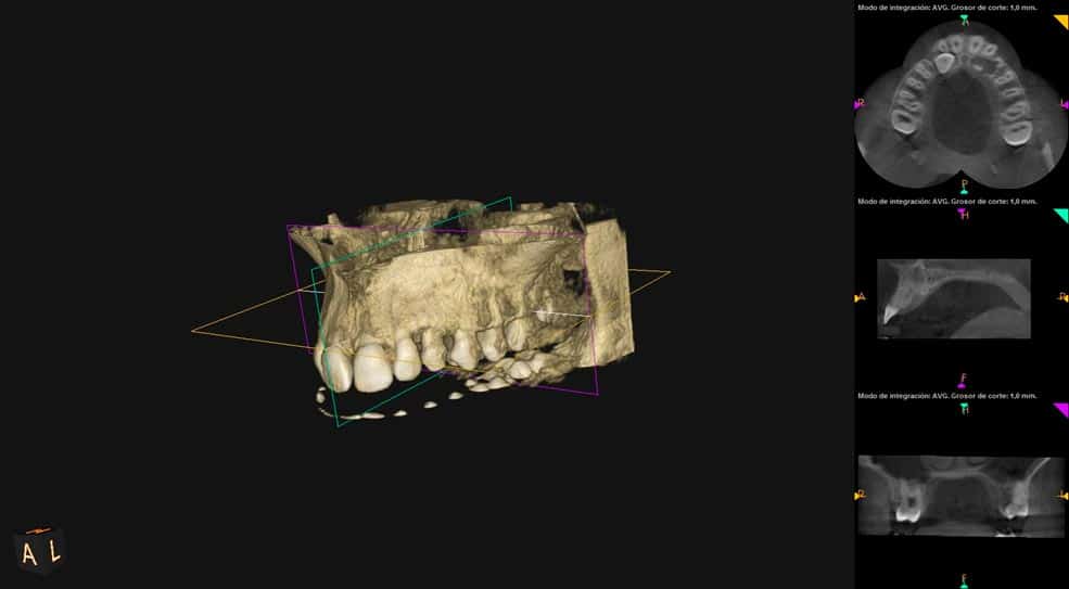 Escaner Dental Radiodiagnóstico 3D Dentadura Clínica Dental en Pinto Dres. de Benito