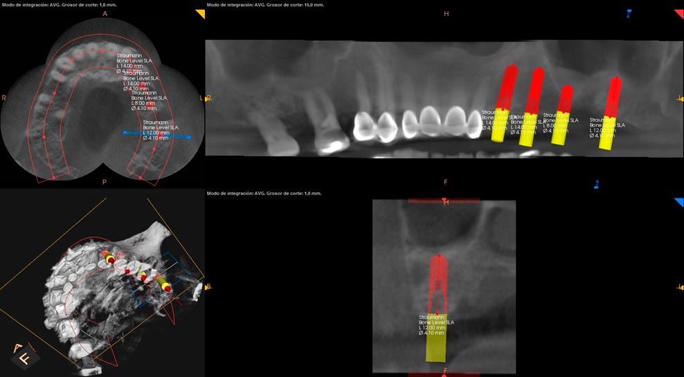 Escaner Dental Radiodiagnóstico 3D Clínica Dental en Pinto Dres. de Benito