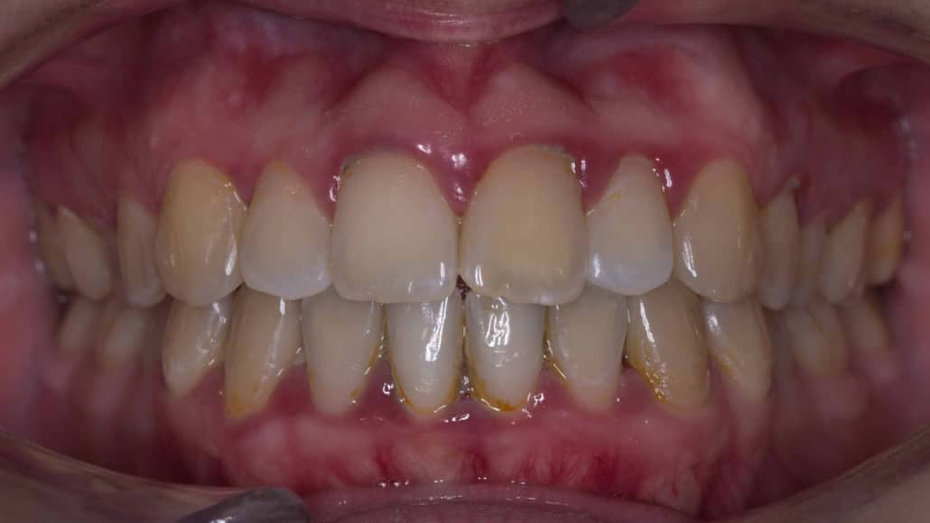 Gingivitis enfermedad de las encías clinica dental pinto