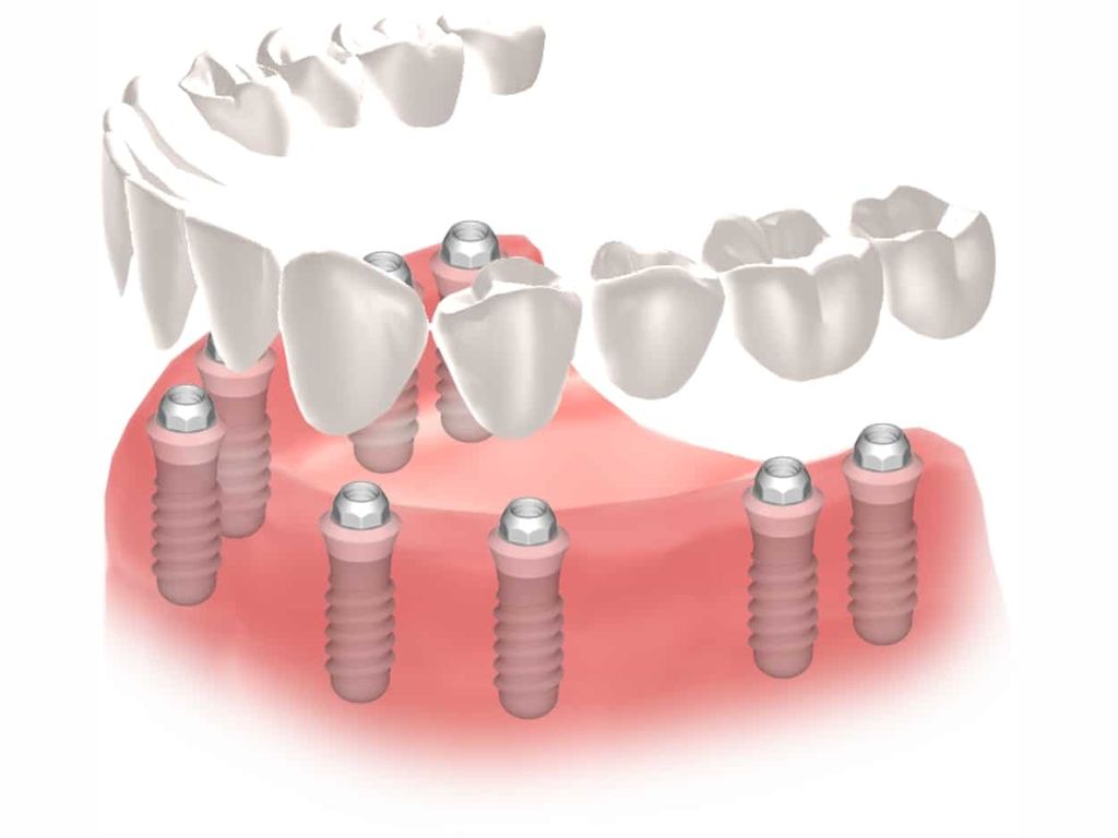 Implantes dentales Straumann clinica dental en pinto