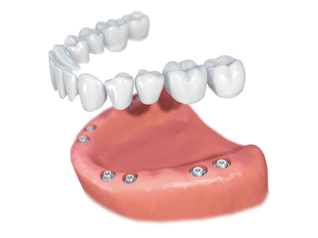 Implantes dentales Straumann clinica dental en pinto