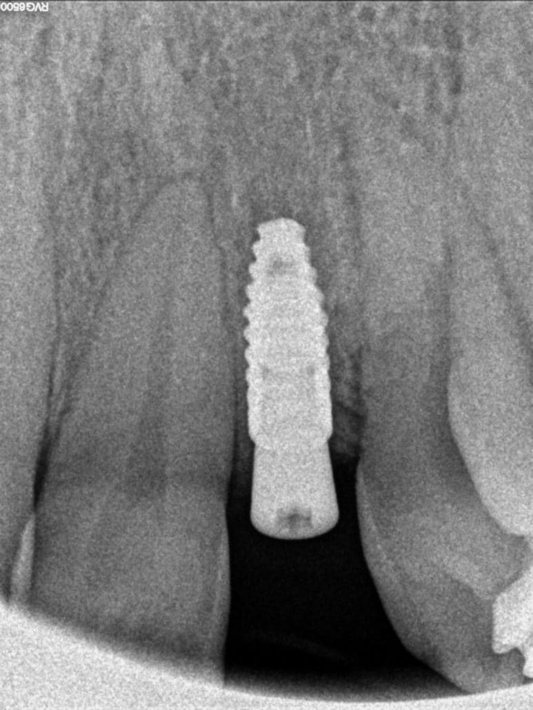 Implante Incisivo Lateral Complejo Clínica Dental en Pinto Dres. de Benito