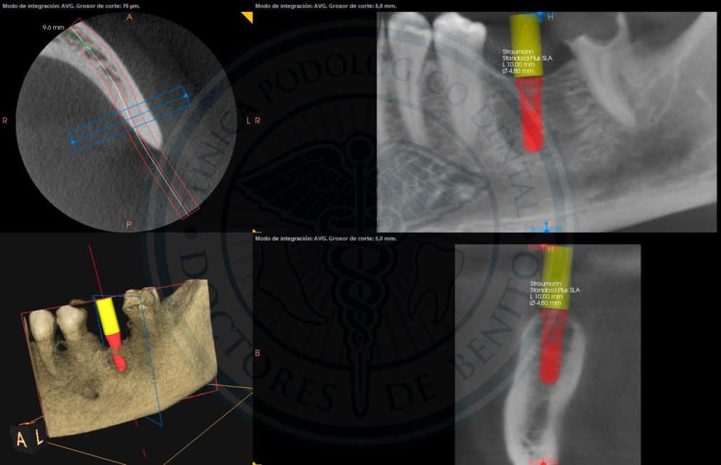 implante Straumann Clínica Dental en Pinto Dres. de Benito