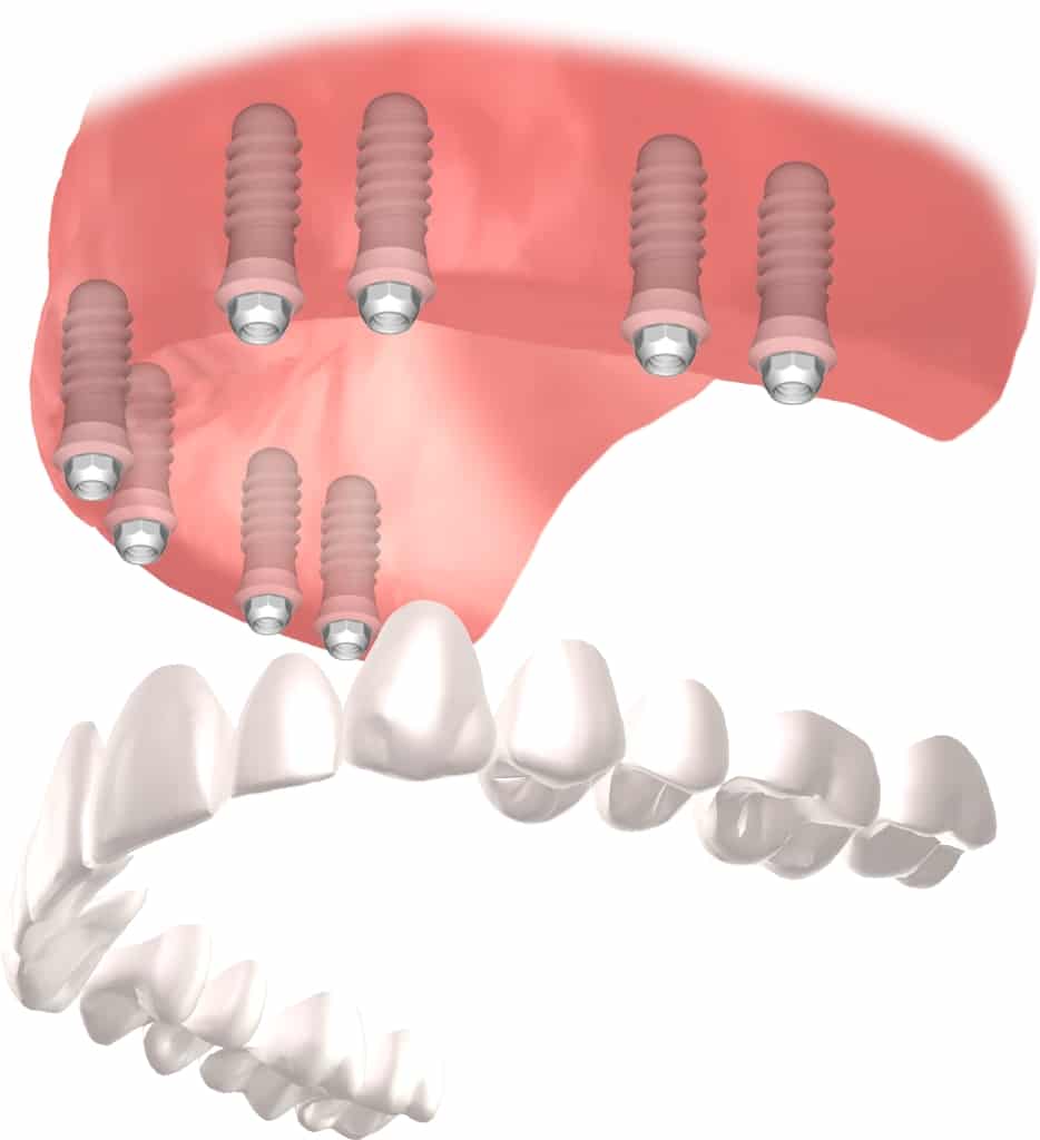 implante Straumann Clínica Dental en Pinto Dres. de Benito