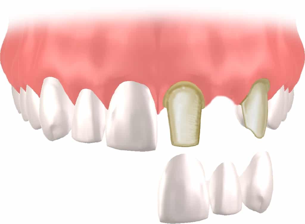 implante Straumann Clínica Dental en Pinto Dres. de Benito