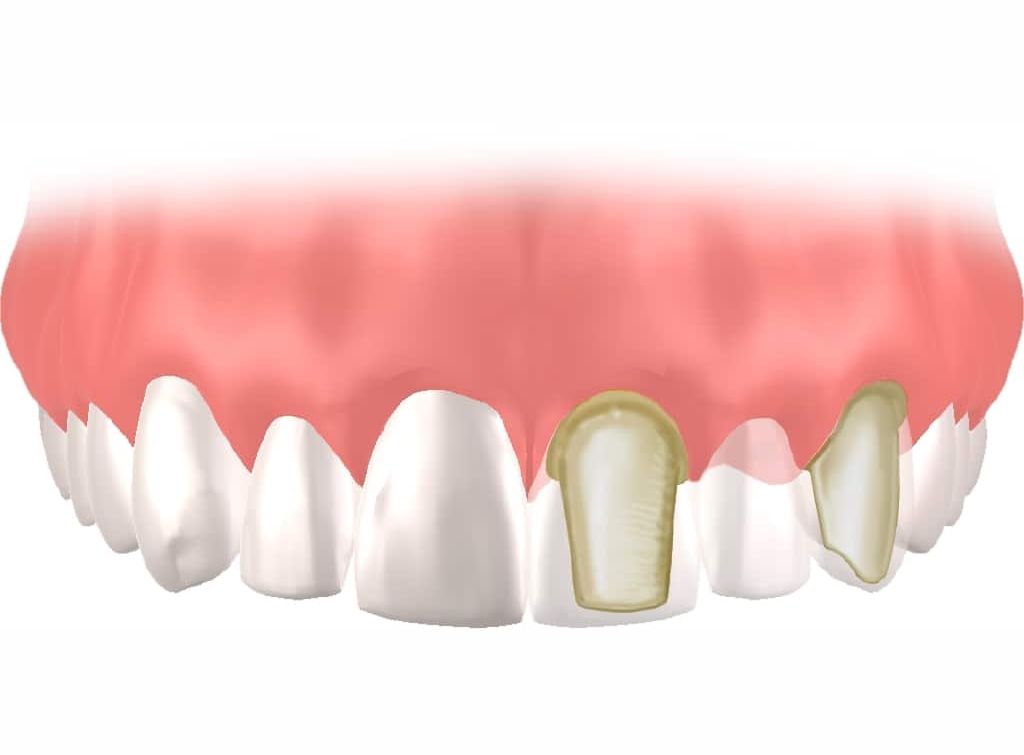 implante Straumann Clínica Dental en Pinto Dres. de Benito