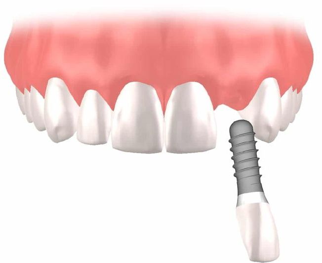 Implantes dentales Straumann clinica dental en pinto