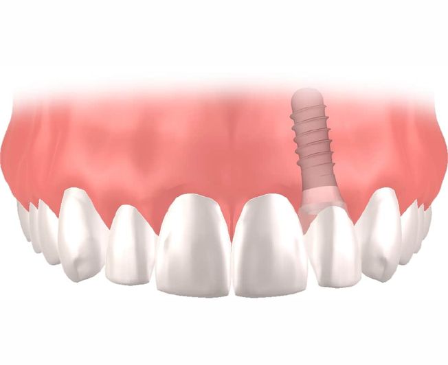 Implantes dentales Straumann clinica dental en pinto