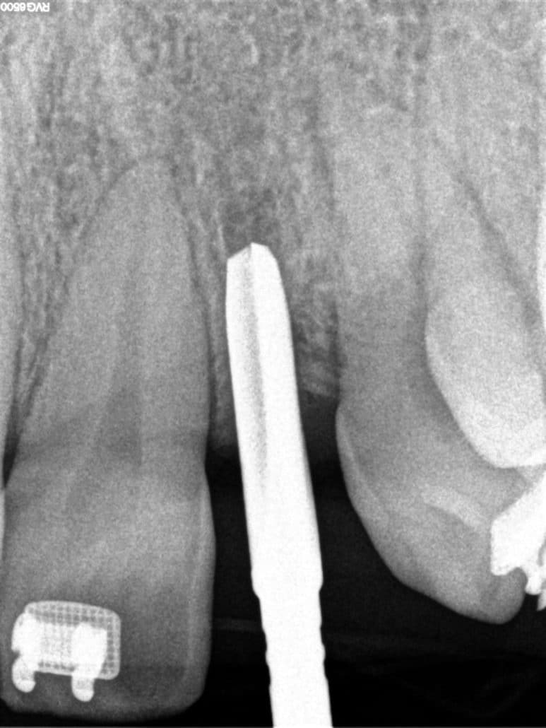 Labrado inserción implante Clínica Dental en Pinto Dres. de Benito