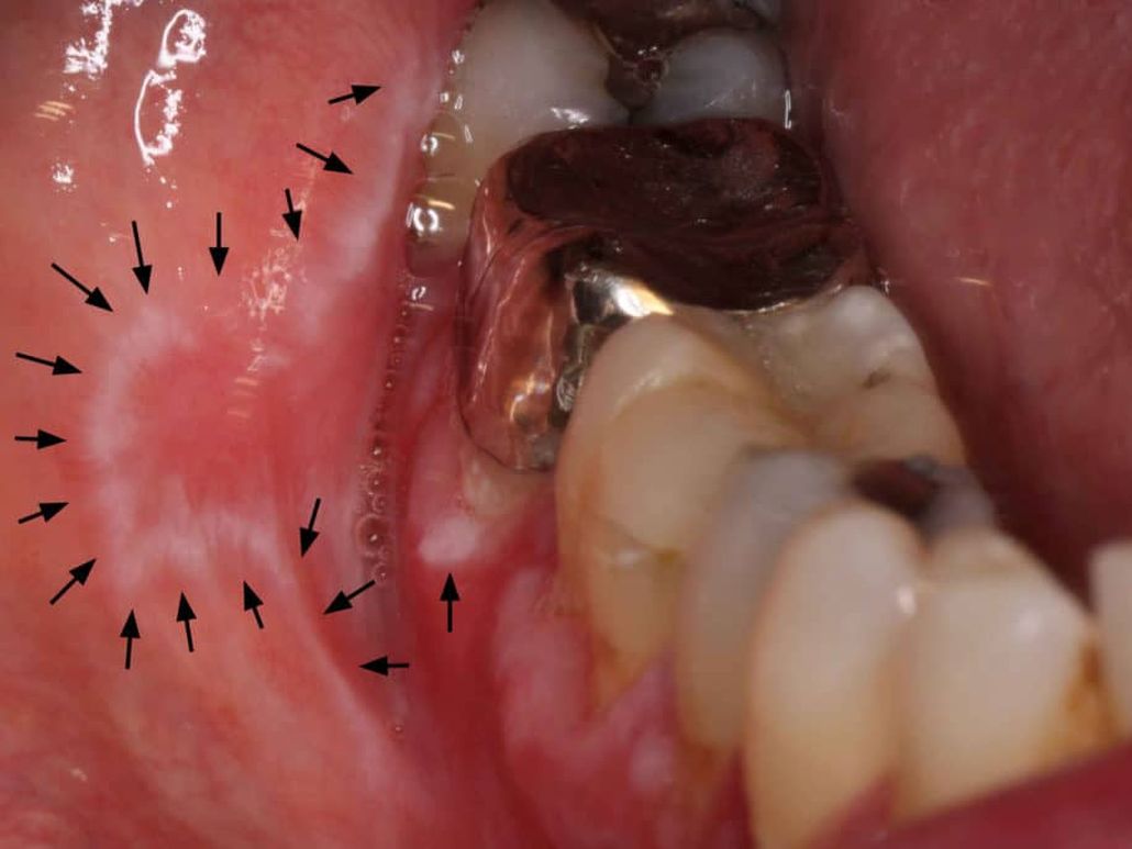 Liquen Plano Oral clinica dental en pinto