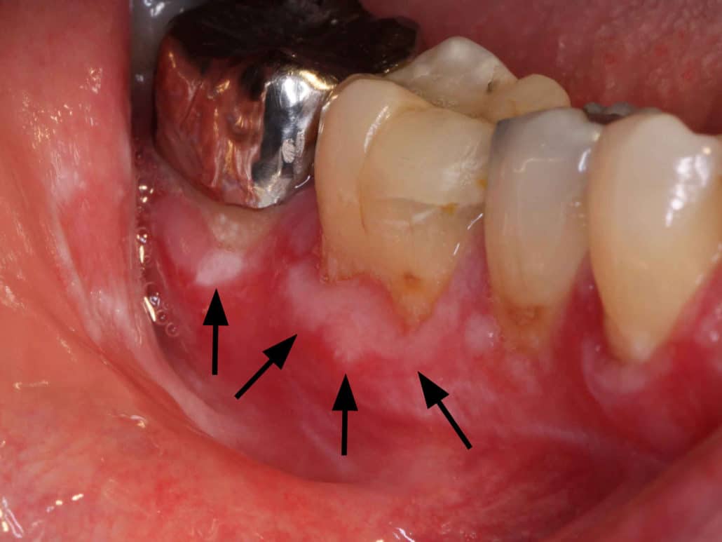 Liquen Plano Oral clinica dental en pinto