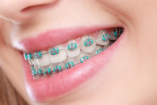 Brackets Convencionales clinica dental pinto