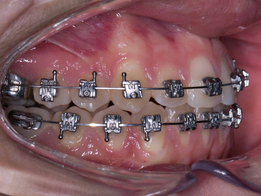 Brackets metálicos de autoligado Carriere clinica dental en pinto