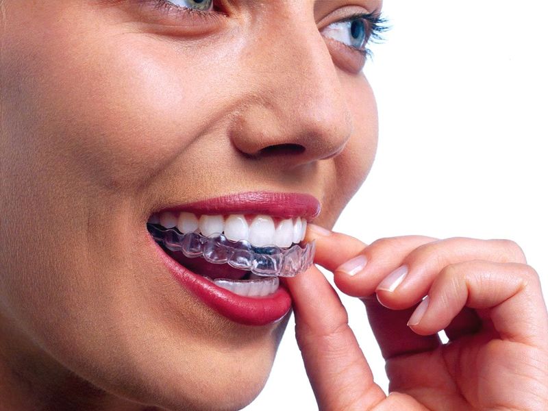 ortodoncia invisible invisalign clinica dental en pinto