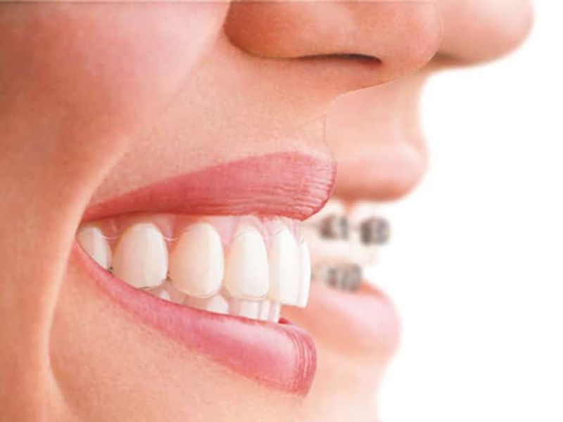 ortodoncia invisible invisalign clinica dental en pinto