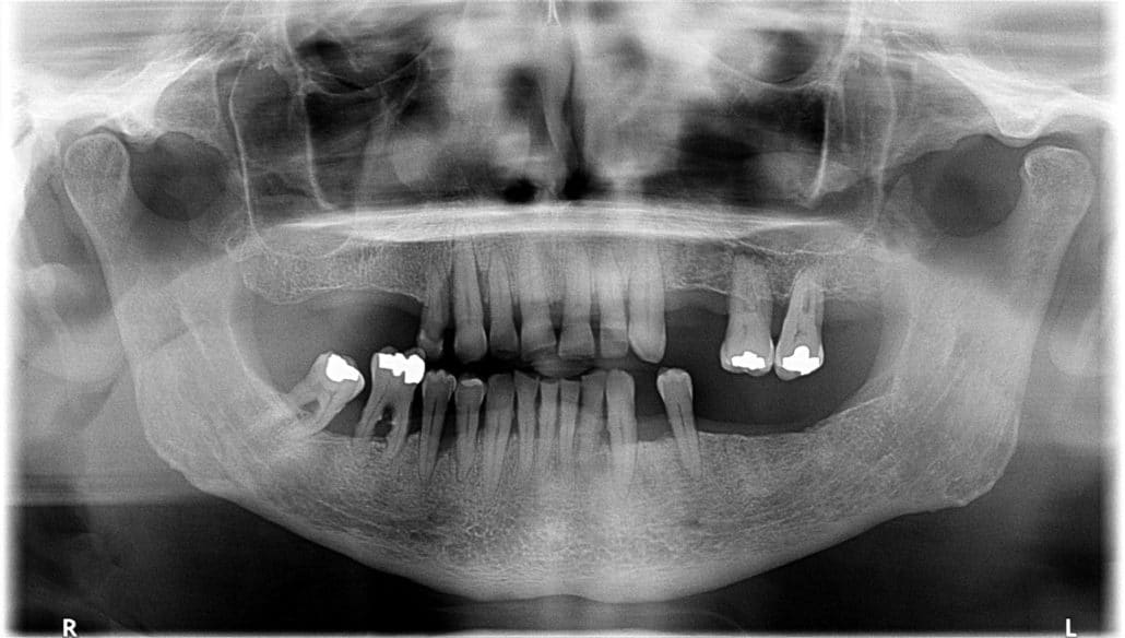 Ortopantomografia de un paciente con enfermedad periodontal Clínica Dental en Pinto Dres. de Benito