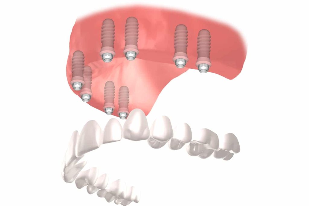 Implantes dentales Straumann clinica dental en pinto