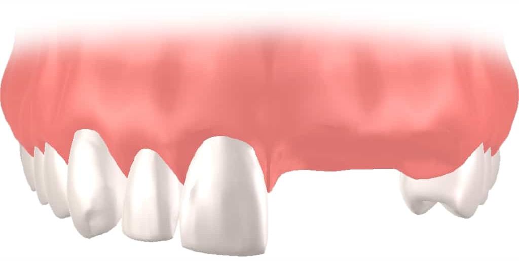 Implantes dentales Straumann clinica dental en pinto