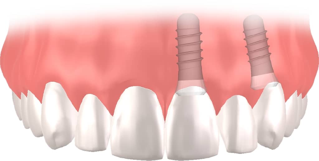 Implantes dentales Straumann clinica dental en pinto