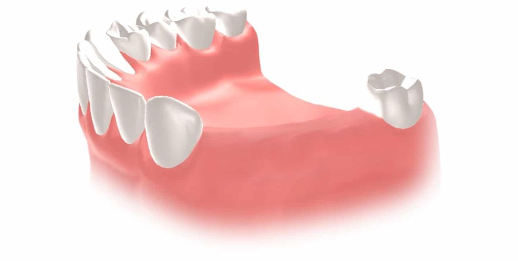 Implantes dentales Straumann clinica dental en pinto