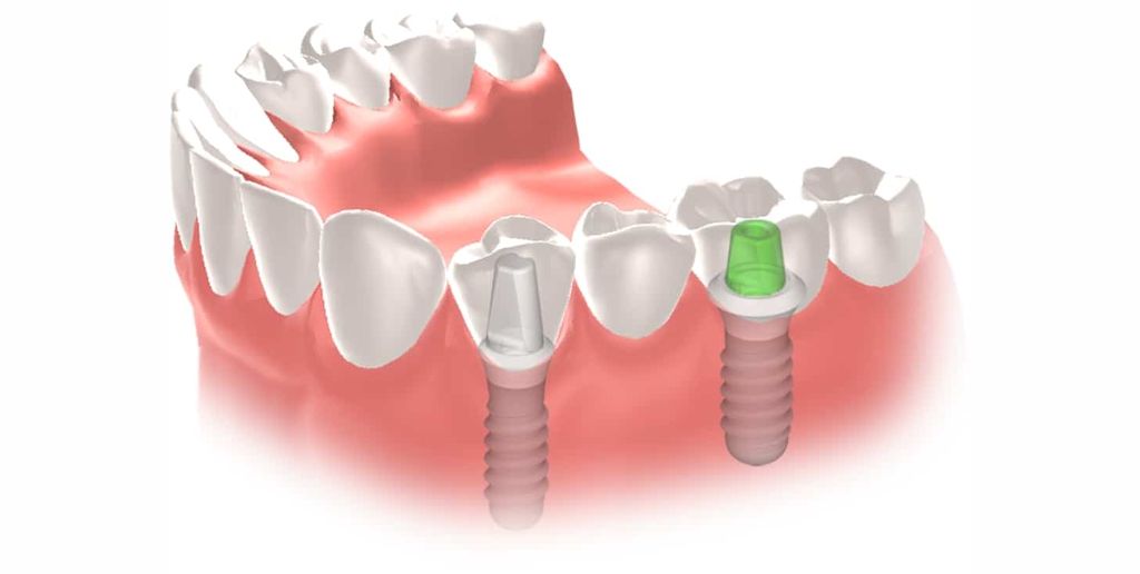 Implantes dentales Straumann clinica dental en pinto