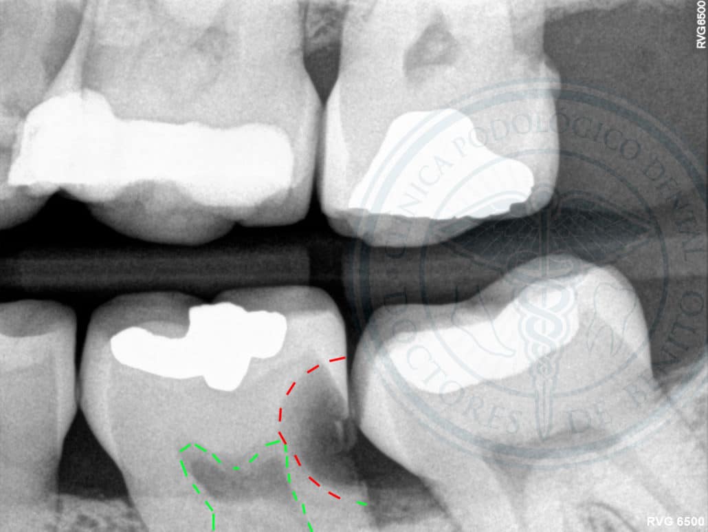 Radiografía de aleta de mordida clinica dental en pinto