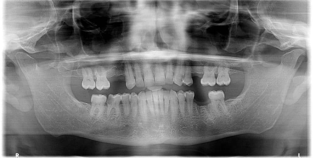 implante Straumann Clínica Dental en Pinto Dres. de Benito