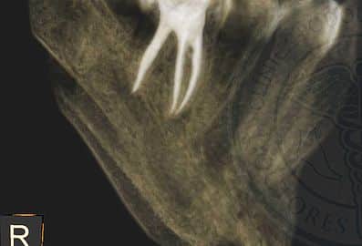 sellado tridimensional endodoncia clinica dental pinto