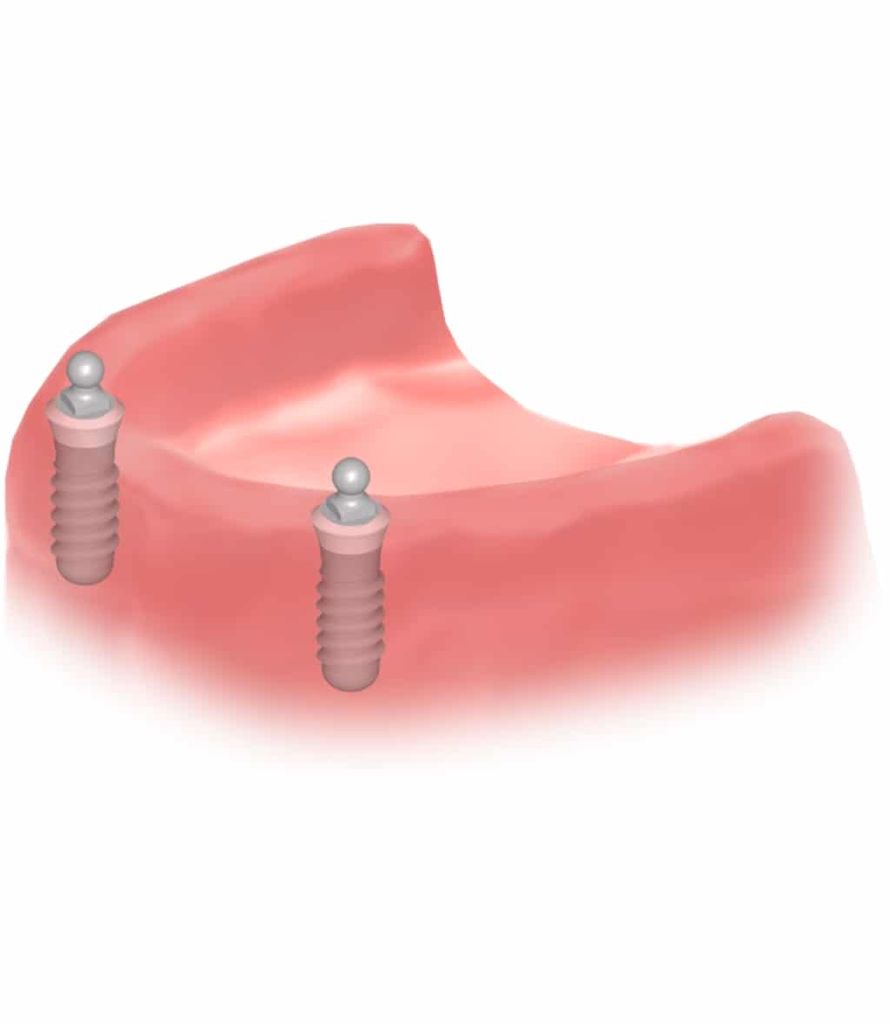 Implantes dentales Straumann clinica dental en pinto