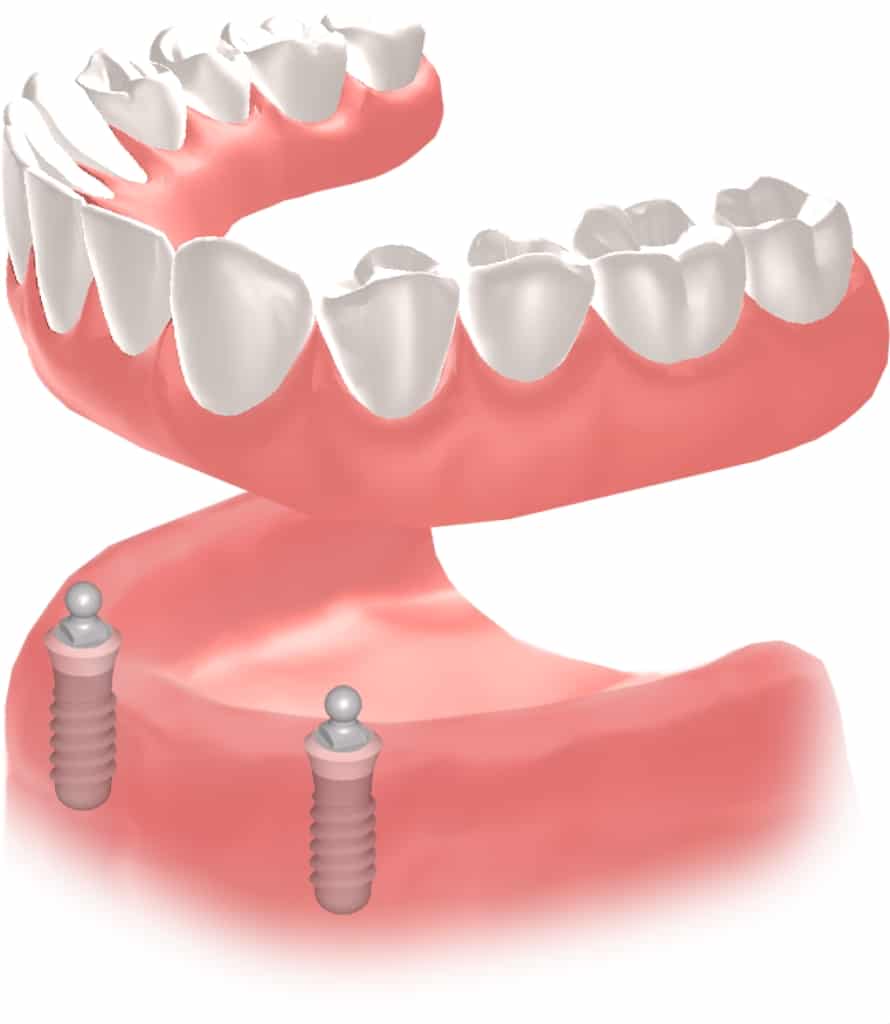 Implantes dentales Straumann clinica dental en pinto