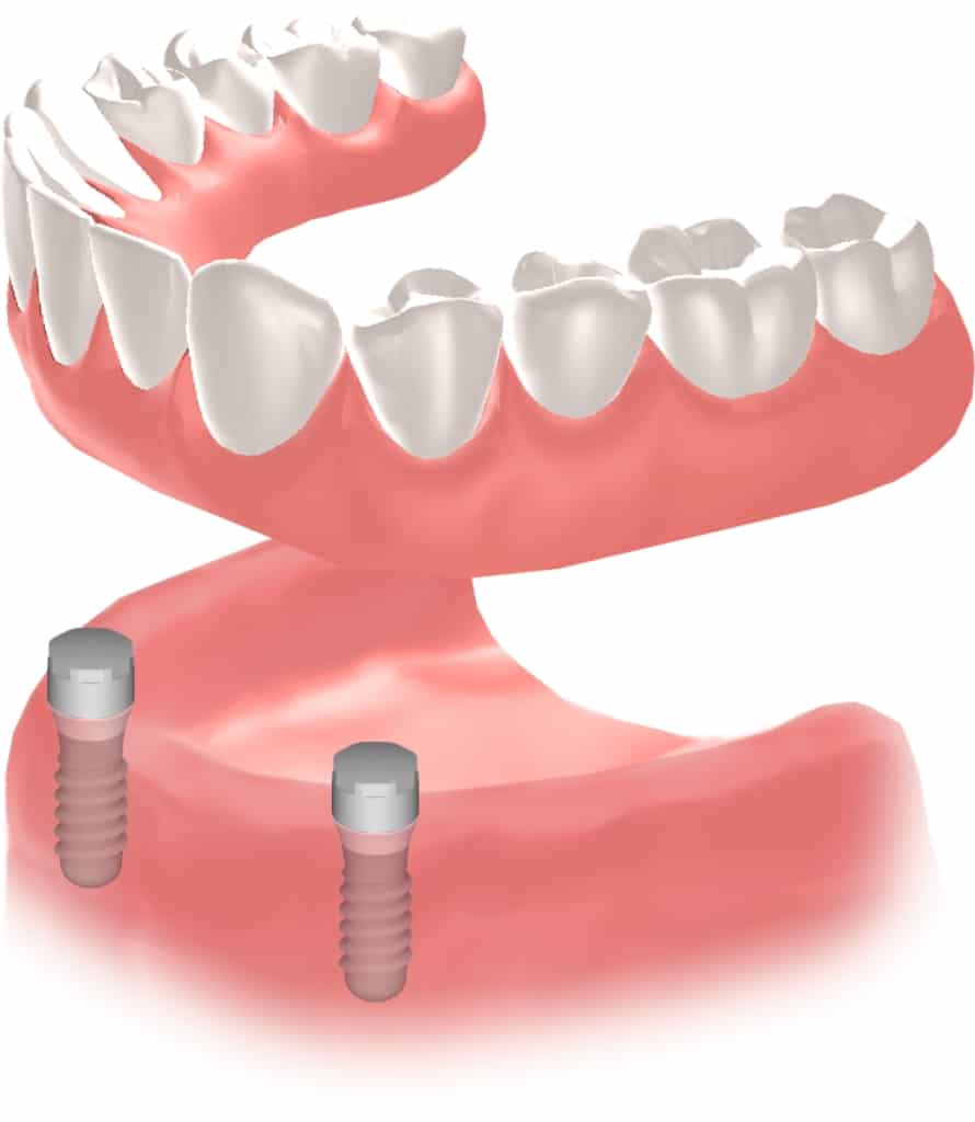 Implantes dentales Straumann clinica dental en pinto