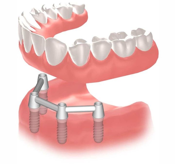 Implantes dentales Straumann clinica dental en pinto