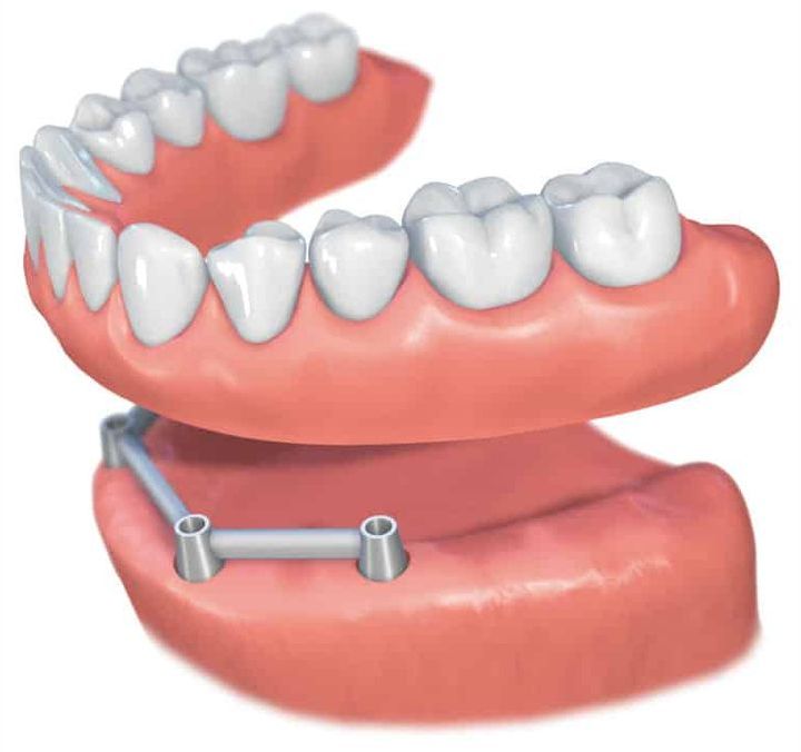 Implantes dentales Straumann clinica dental en pinto