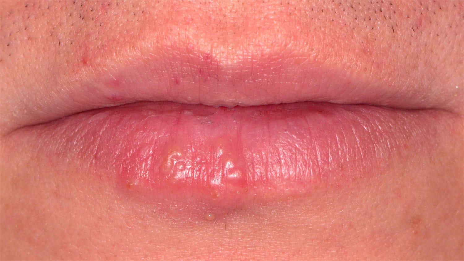 Virus del Herpes Labial clinica dental pinto